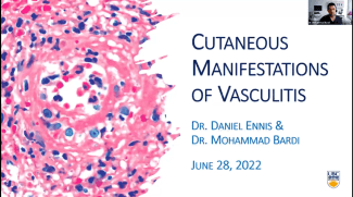 June 28, 2022:  VCH Family Practice Rounds Cutaneous Manifestations of Vasculitis by Dr. Mo Bardi and Dr. Daniel Ennis